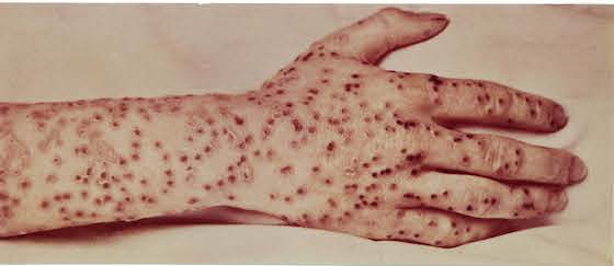 Rash With Scabs - Doctor answers on HealthTap