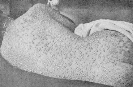 Smallpox: the “Speckled Monster”