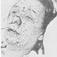 One Big Sore: Confluent Smallpox