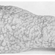 There’s Nothing Small About Smallpox