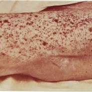 Everyone Died: Hemorrhagic Smallpox