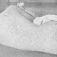 Smallpox: the “Speckled Monster”